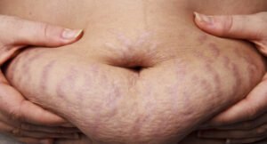  Barriga pós-parto com estrias e cicatriz de cesárea, símbolo da maternidade real